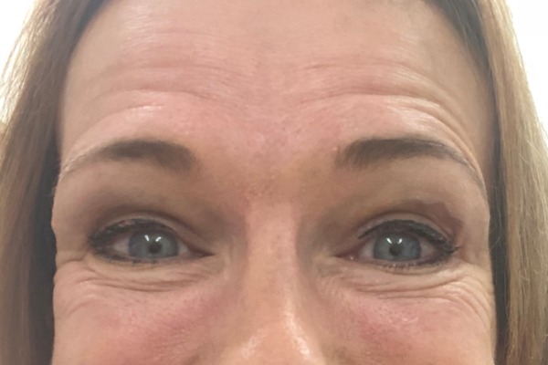 Forehead before Botox® treatment