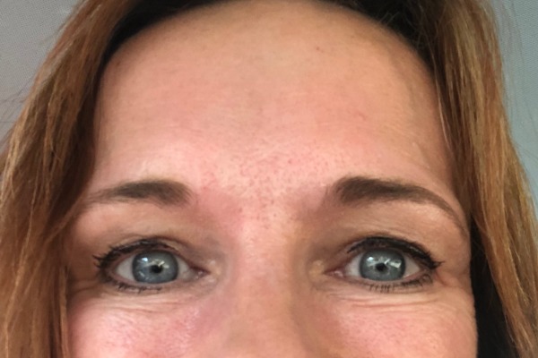 Forehead 2 weeks after Botox® treatment